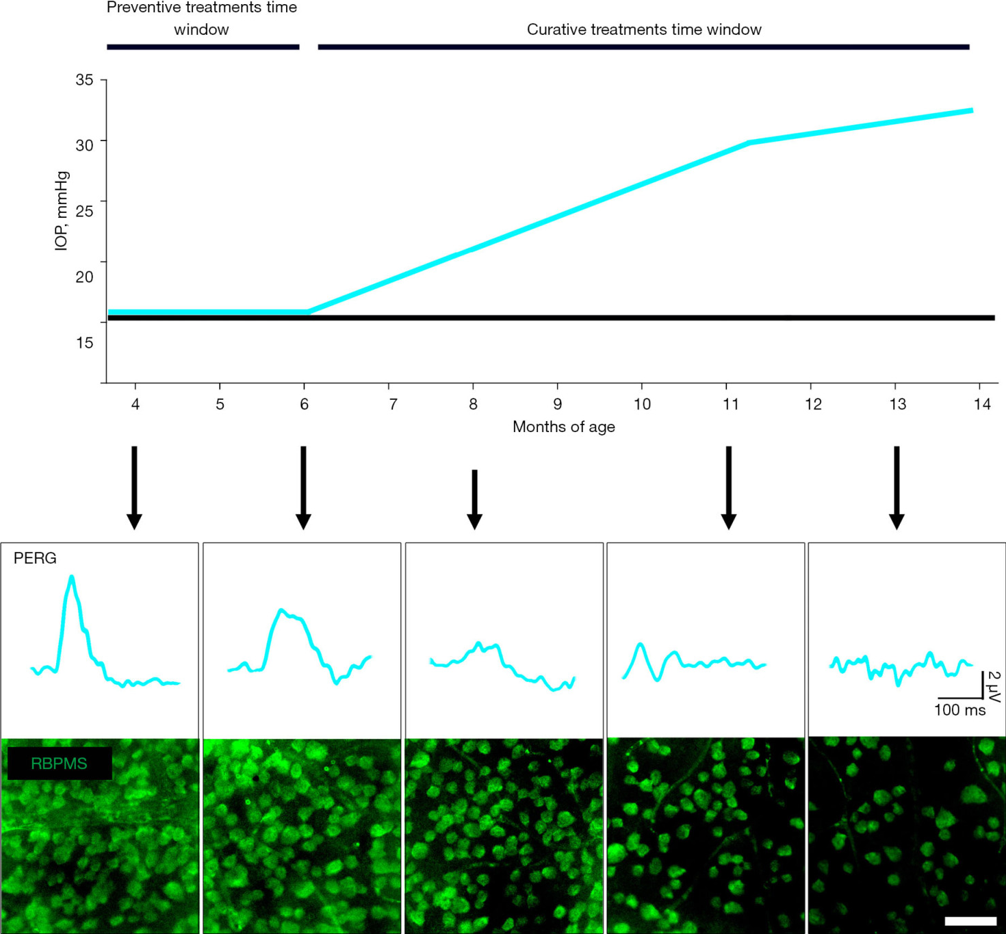  Figure 2 Summary of the typical outcomes deriving from the DBA/2J inherited mouse model of glaucoma. Graphical representation of the age-dependent profile of IOP in normotensive mice (black line) and DBA/2J mice. Arrows indicate the age-matched outcomes of RGCs activity assessed with PERG and density of RGCs immunolabeled for RBPMS. Scale bar: 50 μm. IOP, intraocular pressure; PERG, pattern electroretinogram; RBPMS, RNA-binding protein with multiple splicing; RGCs, retinal ganglion cells.