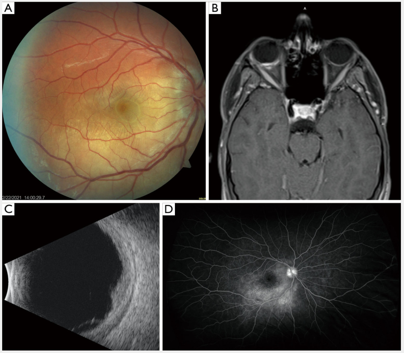 Figure 1 BALAD in a case of posterior scleritis. (A) Fundus photograph of the right eye. (B) T1-weighted MRI of the brain and orbits demonstrating focal enhancement of the right posterior globe. (C) B-scan ultrasound of the right eye. (D) Fluorescein angiogram of the right eye 5 days after initial presentation. BALAD, bacillary layer detachment; MRI, magnetic resonance imaging.