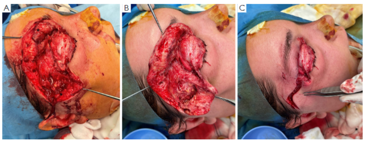 Figure 3 Intraoperative views from the initial debridement. (A) Pre-debridement, with involvement of the right upper lid dermal and pre-septal necrosis, and superficial and deep temporal fascia necrosis extending to the anterior temporal fossa (see asterisk). (B) Post-debridement. (C) Closure of the wound site. This image is published with the patient’s consent.