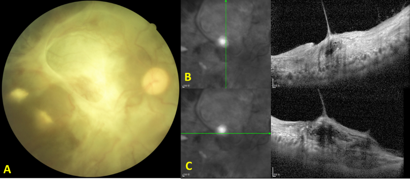 图1 病例1右眼眼底照相和OCT图 Figure 1 Case 1 Fundus photograph and OCT image of the right eye