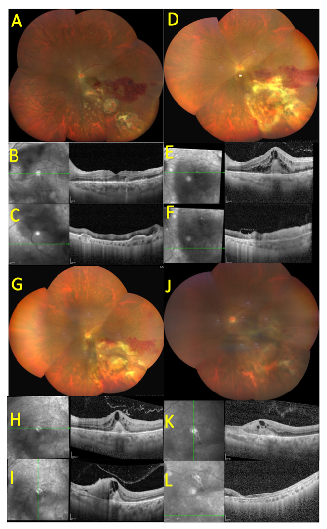 图2 病例1左眼初诊和治疗经过及预后 Figure 2 Case 1 Initial presentation, treatment course, and prognosis of the left eye.