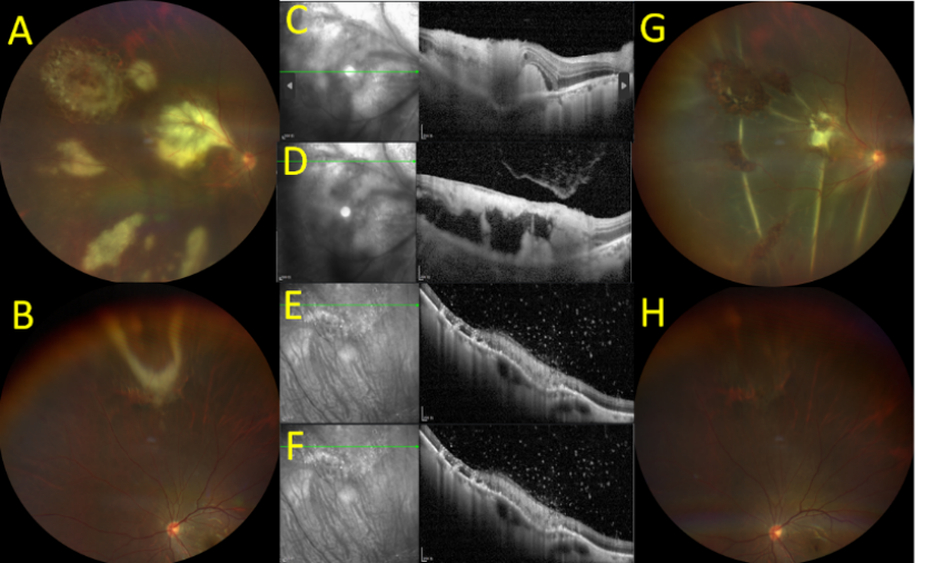 图3 病例2抗弓形虫治疗前的2次眼底检查 Figure 3. Case 2 Two fundus examinations before initiation of anti-toxoplasma treatment.