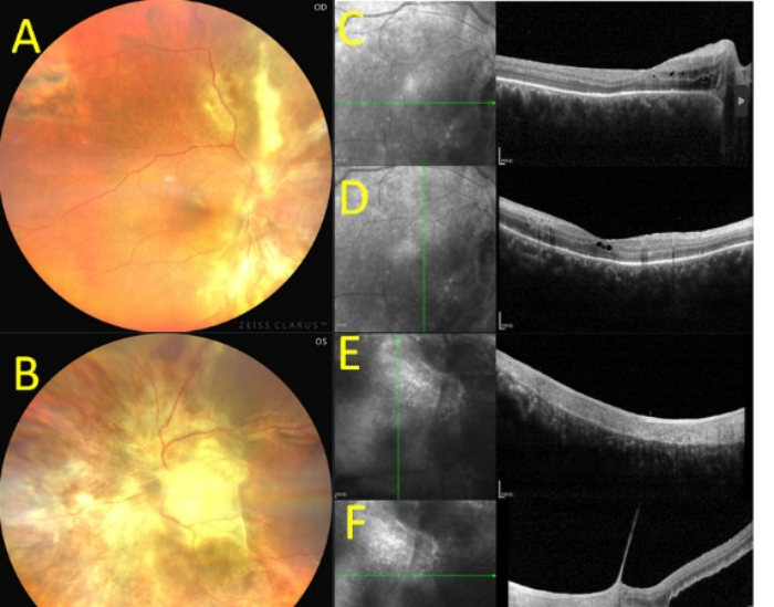 图4 病例2抗弓形虫治疗10ｄ后的眼底和OCT图 Figure 4. Case 2 Fundus and OCT imaging 10 days post anti-toxoplasma therapy.
