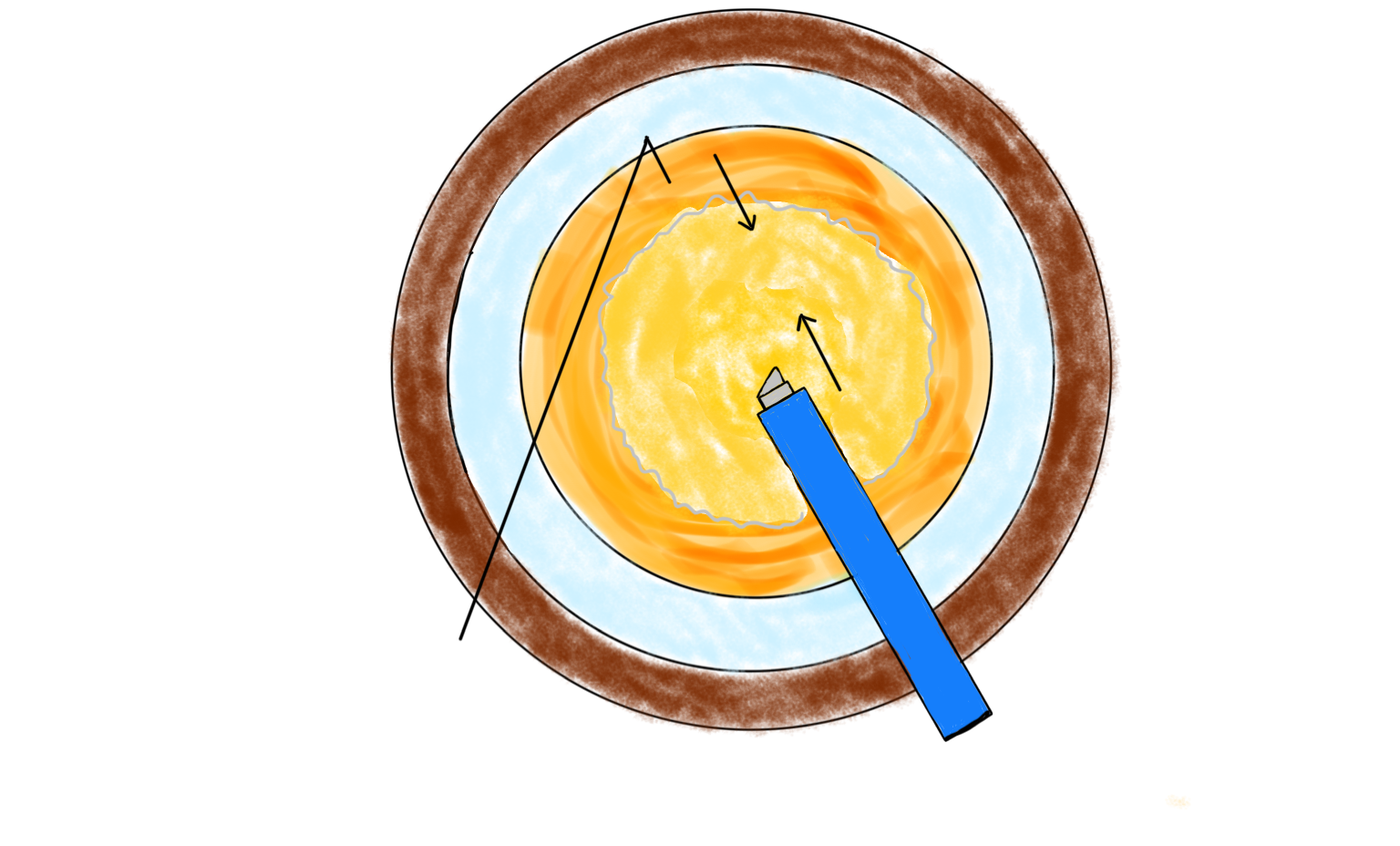 图4 劈核钩与超声乳化针头在同一经线对向用力劈核Figure 4 The nucleus-splitting hook and the phacoemulsification needle apply force in opposite directions long the same meridian to split the nucleus