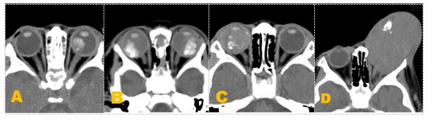 图3分期影像特征示图 Figure 3 Diagram of staging CT imaging features 