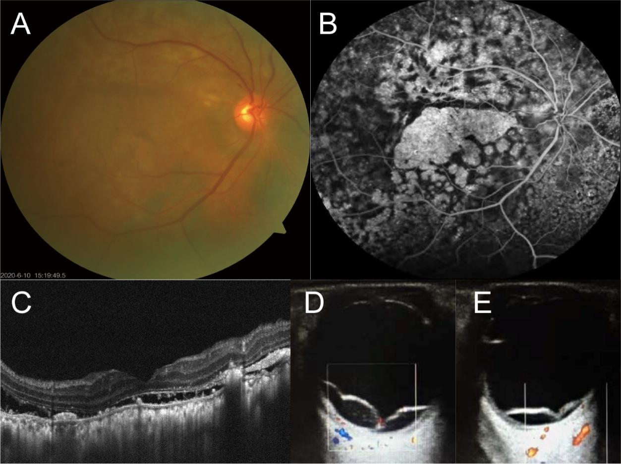 Figure 1 Multimodal images of the patient’s right eye and follow-up B-scans of both eyes of the patient