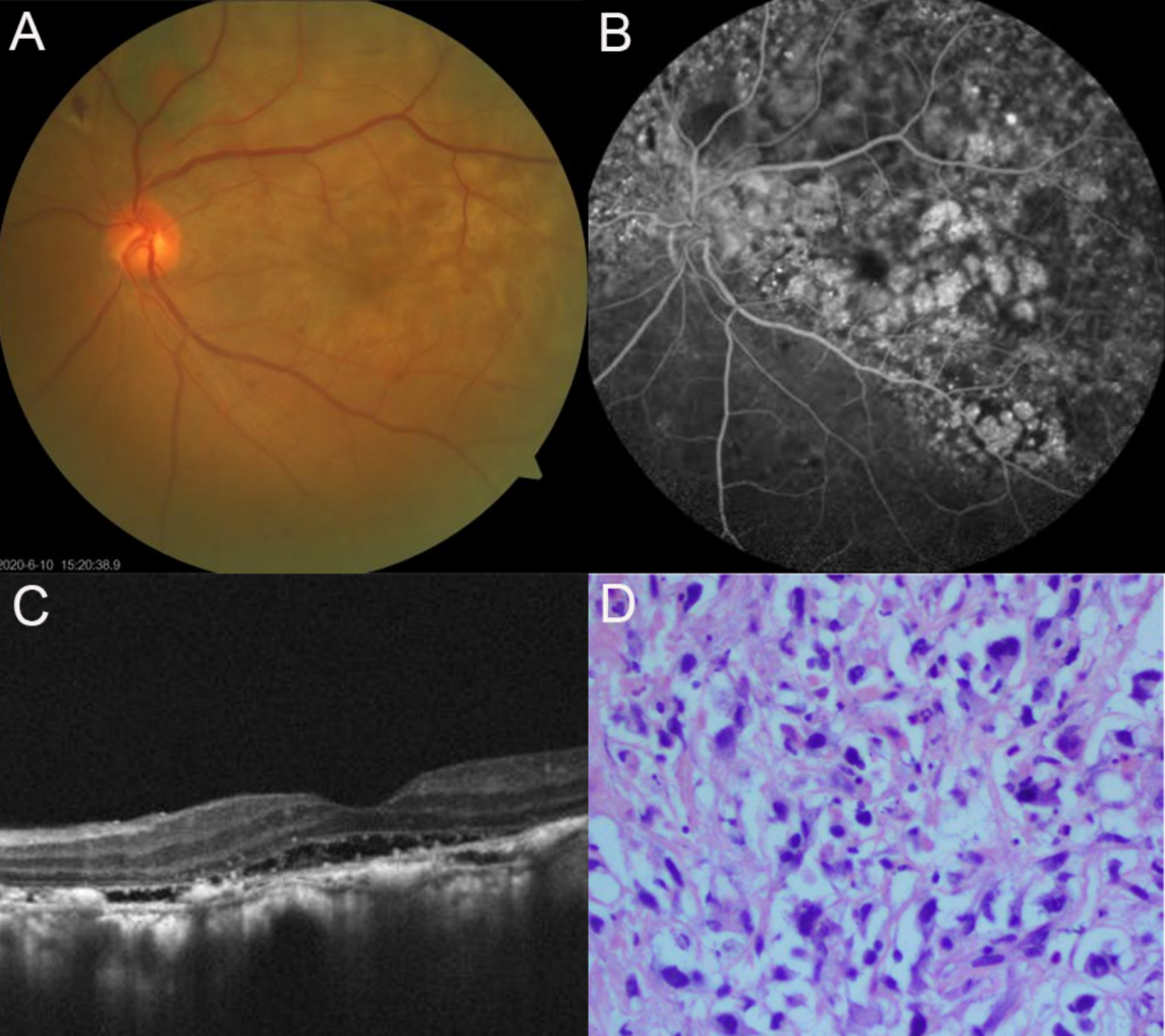 Figure 2 Multimodal images of the patient’s left eye and the histopathological finding of his adrenal tissue
