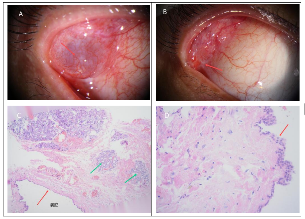 图1 病例13右眼睑叶泪腺导管囊肿患者的临床及病理检查 Figure 1 Clinical and pathological examination of a lacrimal duct cyst in the palpebral lobe of the right eye of Case 13