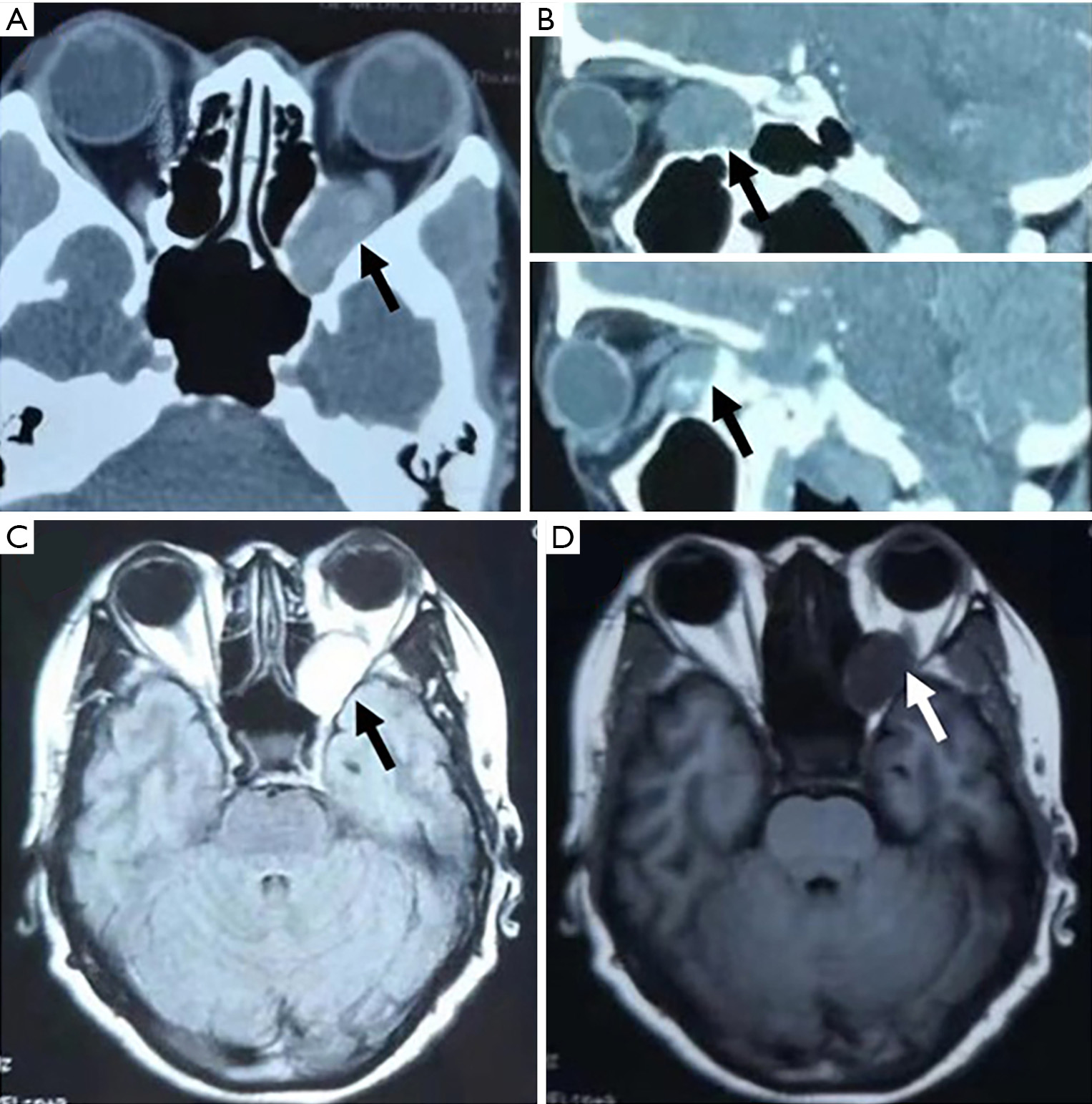 Transnasal Endoscopic Approach For Orbital Apical Cavernous Hemangiomas A Case Report 